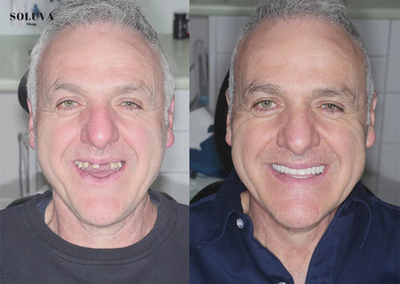 SmileSecure - Zekerheid bij elke lach - 2e Gratis!