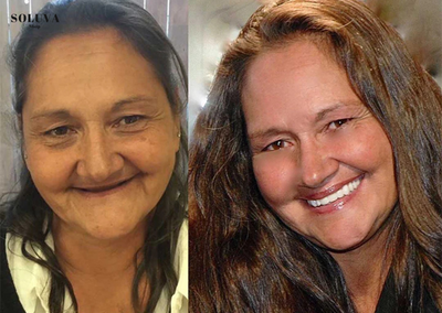 SmileSecure - Zekerheid bij elke lach - 2e Gratis!