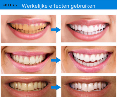 Teeth Essence - Ultra Sterke Tandenbleker - 1+2 Gratis!
