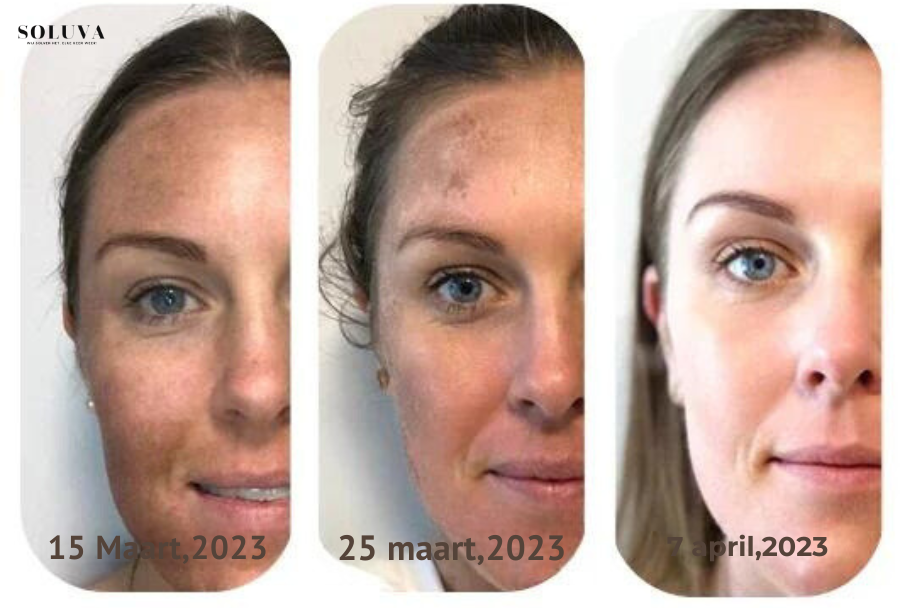 SkinShine - Huidverhelderende Gezichtsserum - 1+1 Gratis!