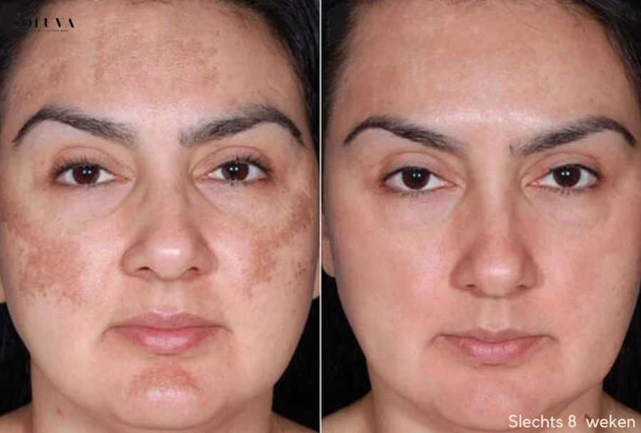 SkinShine - Huidverhelderende Gezichtsserum - 1+1 Gratis!