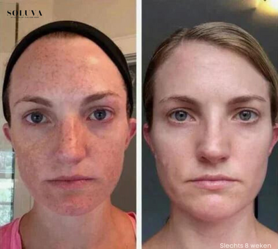 SkinShine - Huidverhelderende Gezichtsserum - 1+1 Gratis!