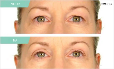 LiftStrips - Onzichtbare Ooglifting