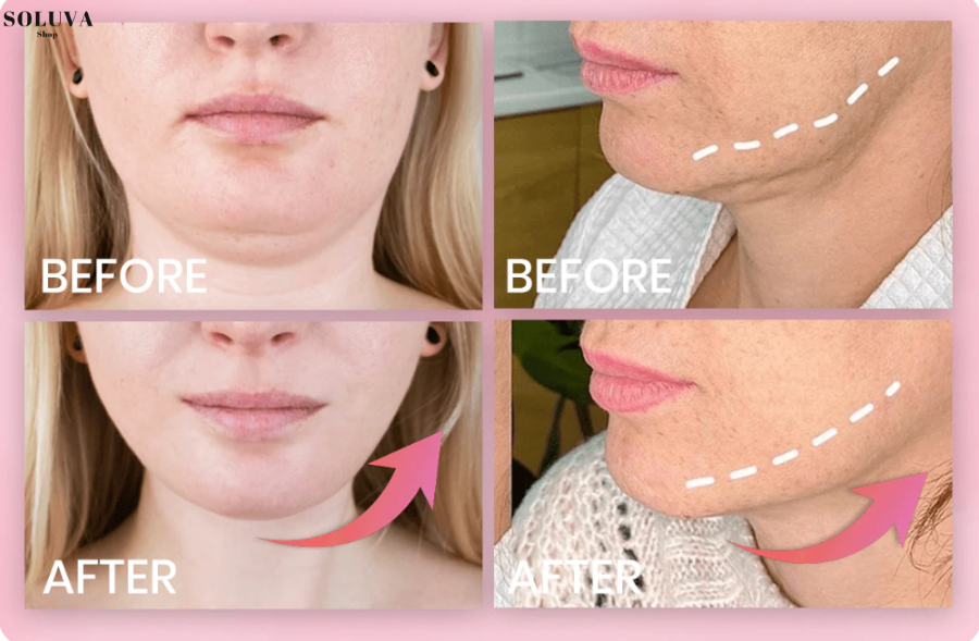 SlimFace  - Onzichtbare Facelift - Winteruitverkoop: 20 Stuks + 20 Stuks gratis!