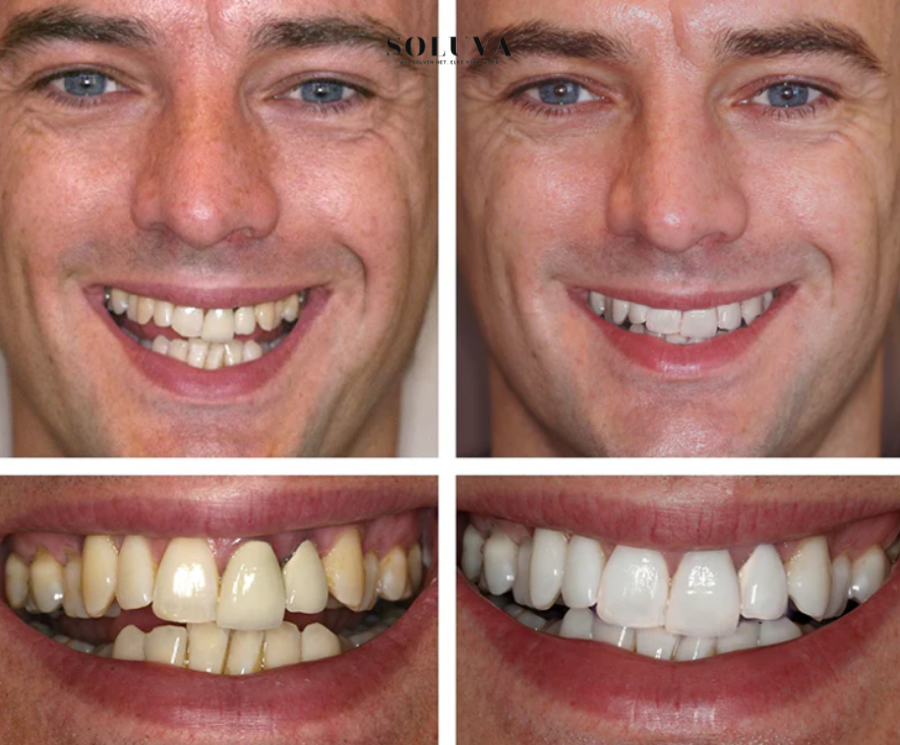 Teeth Essence - Ultra Sterke Tandenbleker - 1+2 Gratis!