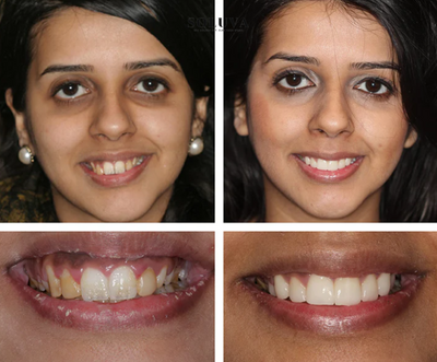 Teeth Essence - Ultra Sterke Tandenbleker - 1+2 Gratis!